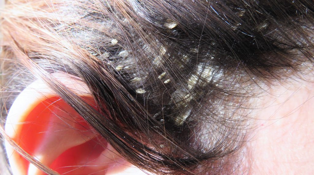 Psoriasis cheveux : comment traiter le psoriasis du cuir chevelu?