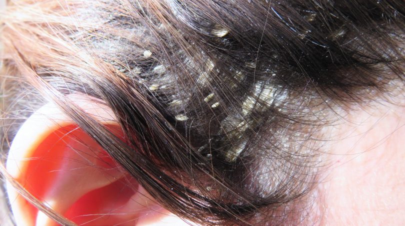 psoriasis cuir chevelu perte de cheveux