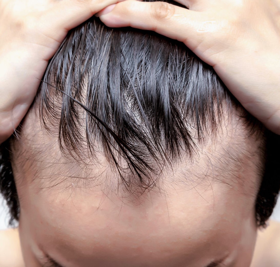 Peut On Faire L Amour Après Une Greffe De Cheveux Greffe de cheveux en Turquie : ce qu'il faut savoir avant l'implant