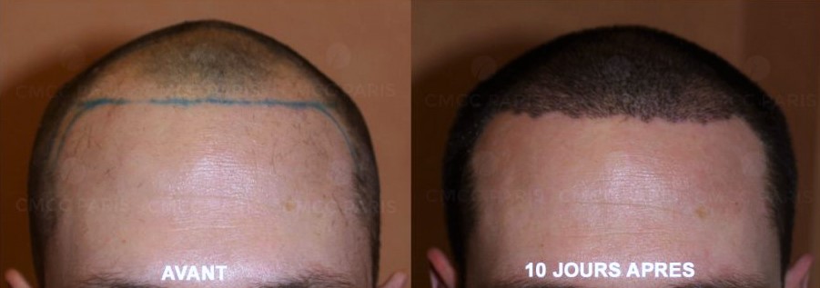 greffe de cheveux après 10 jours avant après